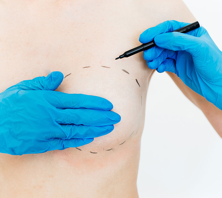 Marking breast for breast augmentation surgery