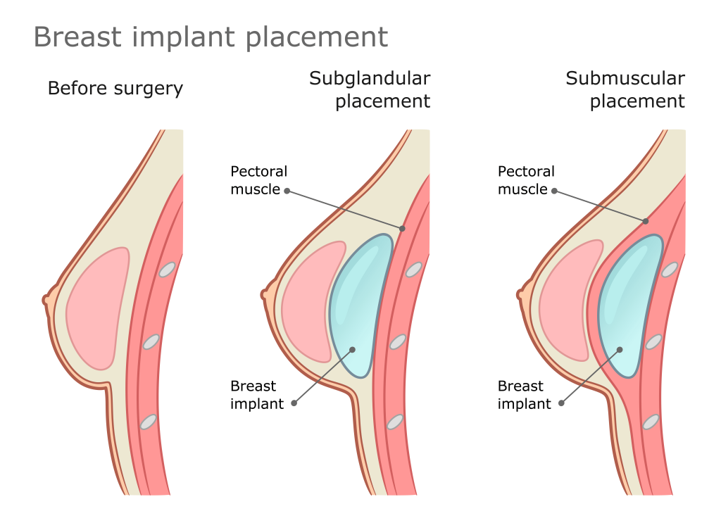 breast-implant-placement-submuscular-subglandular